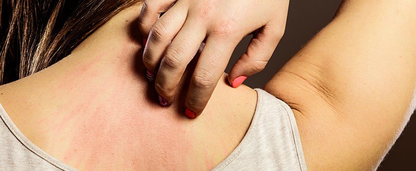 How Do I Treat a Poison Ivy Rash?