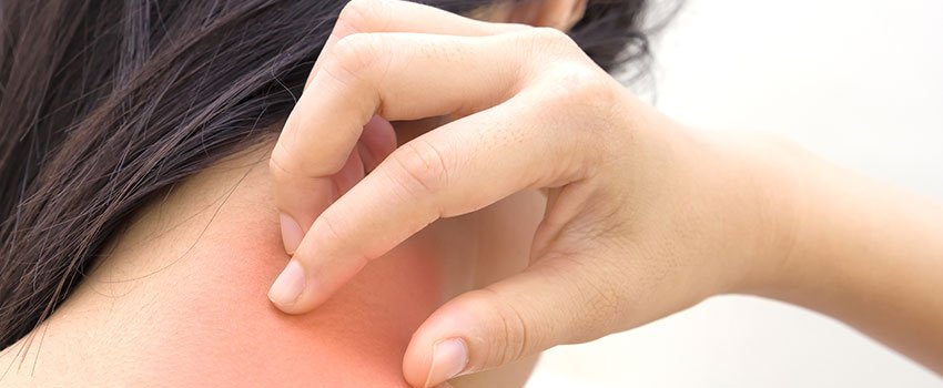 How to Prevent Heat Rash